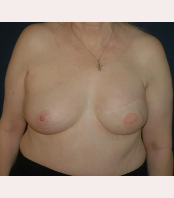 Flap Breast Reconstruction – Case 2