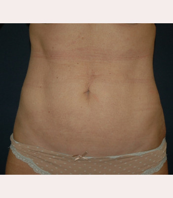 Liposuction – Case 4