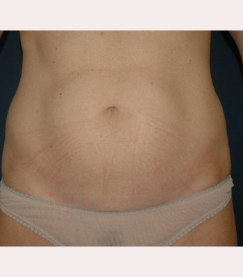 Liposuction – Case 4