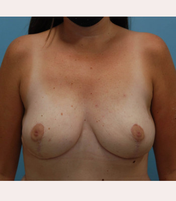 Nipple Sparing Breast Reconstruction – Case 5