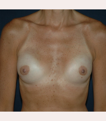 Nipple Sparing Breast Reconstruction – Case 6