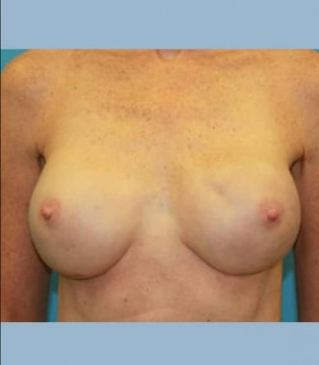 Implant Breast Reconstruction – Case 4