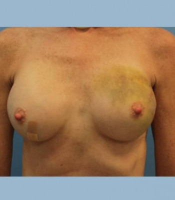 Implant Breast Reconstruction – Case 4