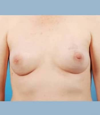 Implant Breast Reconstruction – Case 5