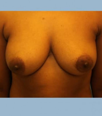 Implant Breast Reconstruction – Case 6