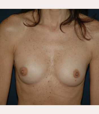 Implant Breast Reconstruction – Case 7