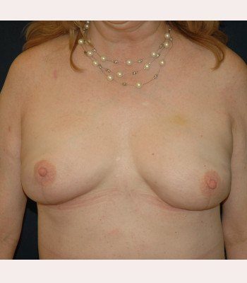 Implant Breast Reconstruction – Case 8
