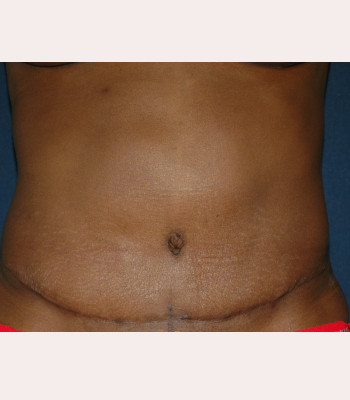 Abdominoplasty – Case 4