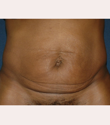 Abdominoplasty – Case 4