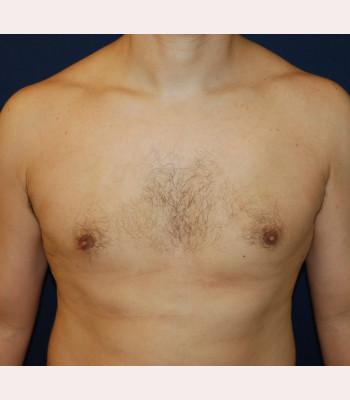 Gynecomastia – Case 4