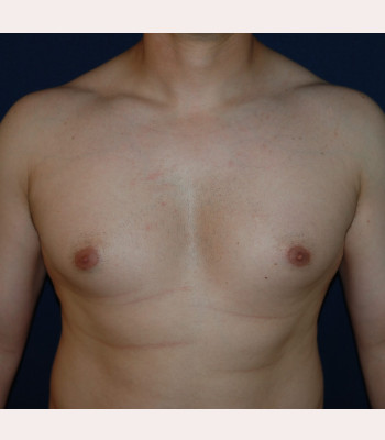 Gynecomastia – Case 4